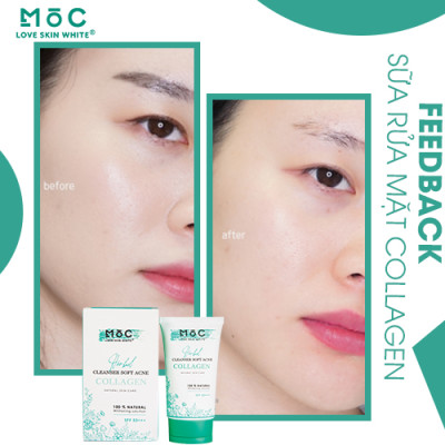 SỮA RỬA MẶT - NGỪA MỤN COLLAGEN - MOC