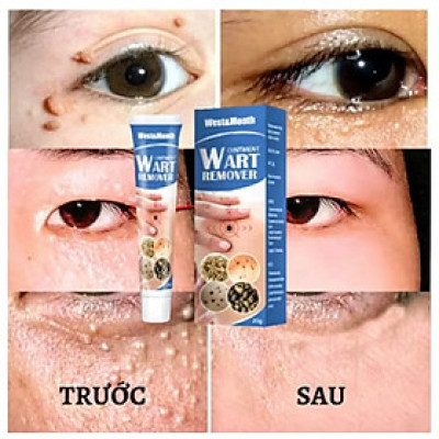 HỘP KEM TRỊ HẾT MỤN CÓC NÚT RUỒI DA NÁM SẠM