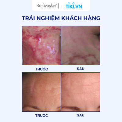 Miếng Dán Ép Sẹo giúp ngăn ngừa hình thành sẹo trên vết thương mới đồng thời làm Xẹp Sẹo Lồi / Phì Đại Rejuvaskin Scar FX 10x20cm