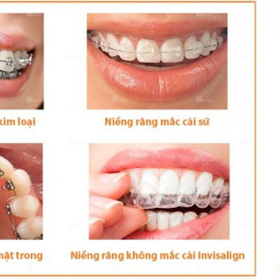 Cho máy Oral B, răng niềng, Set bộ 4 đầu bàn chải đánh răng điện New IP-17A cho răng niềng Minh House-Hàng chính hãng