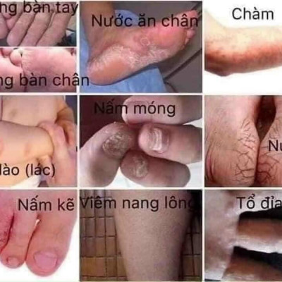 Kem Bôi Nứt Nẻ Á Sừng Tay Chân Ngoài Da - Hàng Nhập Khẩu